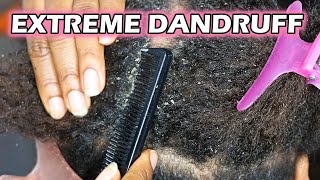 How to remove Dandruff From Natural Hair  DiscoveringNatural [upl. by Whitelaw]