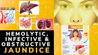 TYPES OF JAUNDICE IN ADULTS  HEMOLYTIC INFECTIVE OBSTRUCTIVE JAUNDICE  Medical Lecture [upl. by Monk]