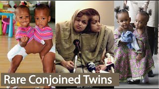 Top 5 Rare Conjoined Twins। Conjoined Twins Separated Successfully । Born Different [upl. by Netnerb]