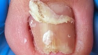 Ingrown toenail causes redness swelling and inflammation take it out in 3 minutes [upl. by Aliehc]