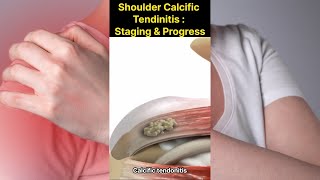 Shoulder Calcific Tendinitis  Progress and Staging [upl. by Jurdi]