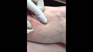 Foam Sclerotherapy with Asclera [upl. by Netsruk]