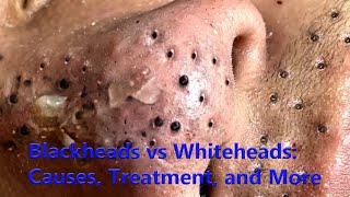 Blackheads vs Whiteheads Causes Treatment and More [upl. by Seroled492]