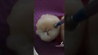 dentalcaries cavite dentist smiledental dentalsmiledesigning [upl. by Birkett]