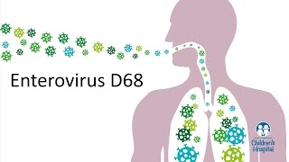 Enterovirus D68  Pediatric Expert Tips [upl. by Kirven]