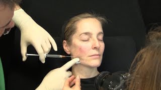 Liquid Facelift – Video Unterspritzung mit Hyaluronsäure – Zeitraffer Facelift ohne OP [upl. by Keily251]