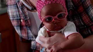 CLIP Restoring Vision to an Infant Born with Cataracts  The Science of Healing [upl. by Giark]