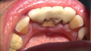 Ultrasonic Teeth Cleaning Cosmetic Dentistry Los Angeles  8187760055 [upl. by Seow]