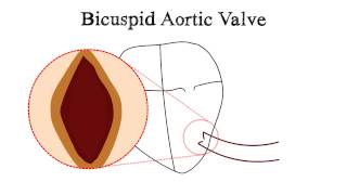 Bicuspid Aortic Valve BAV and Aortic Stenosis [upl. by Airahcaz360]