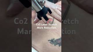 Stretch Marks and Loose Skin  Co2 Laser [upl. by Dina797]