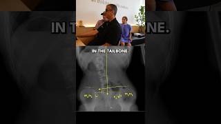 Scoliosis Back Pain Helped with Coccyx amp S3 Adjustment chiropractic shorts [upl. by Alain]