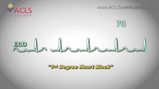 First Degree Heart Block by ACLS Certification Institute [upl. by Anitsirt]