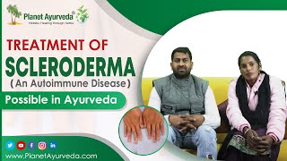 Treatment of Scleroderma Systemic sclerosis An Autoimmune Disease  Possible in Ayurveda [upl. by Meela]