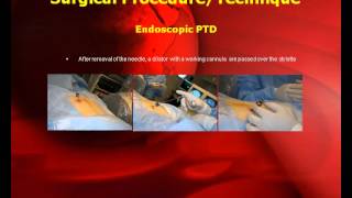 Posterolateral Endoscopic Thoracic Microdiscectomy with GPS System [upl. by Marcelo366]