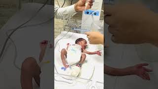 Nasogastric tube feeding in newborn baby  Ryles tube feeding procedure in newborn baby [upl. by Nonnair]