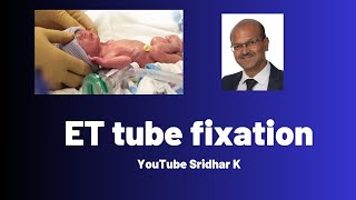 ET tube fixation l How to fix tube securely in babies [upl. by Enomis]