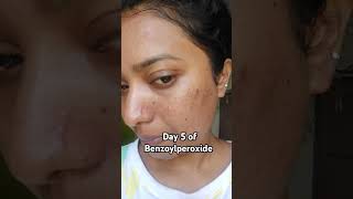 Day 5 of Benzoylperoxide benzoylperoxide skincare acne combinationskin skincareroutine pharma [upl. by Aber]