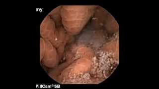 Capsule endoscopy in cirrhosis Portal Gastropathy [upl. by Erie]