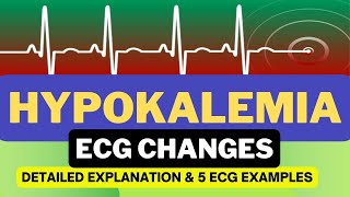 ECG Changes in Hypokalemia  Hypokalemia ECG Changes  Detailed Explanation [upl. by Paresh]