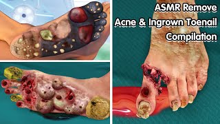 ASMR Remove Acne amp Ingrown Toenail Compilation  Deep Cleaning Animation [upl. by Haerr]