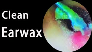 Quickly remove earwax that causes hearing loss pick 対処するごみ 消除背景音 [upl. by Yesmar]