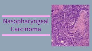 Nasopharyngeal carcinoma  etiology  pathology  diagnosis  management  EBV [upl. by O'Mahony]