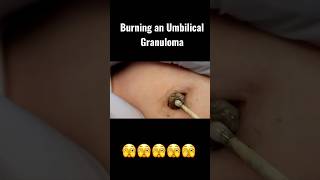 BURNING AN UMBILICAL GRANULOMA 🔥🔥🔥🔥 baby pediatrics [upl. by Leuqim]