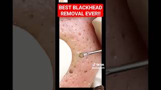 Best BLACKHEAD REMOVAL Ever  So Satisfying shorts [upl. by Jona]