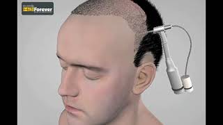 HairForever Hairtransplant  FUEtechnique vs FUTtechnique  Final [upl. by Petulia]