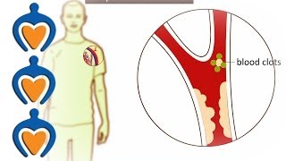 Thrombosis  What is it and how is it treated [upl. by Lemor200]