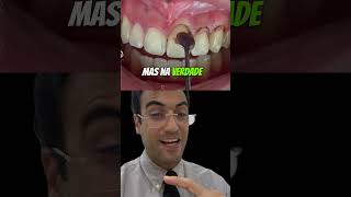 DENTES CURTOS drmiltonresponde [upl. by Siuluj]