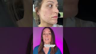 Accutane Transformation and Timeline [upl. by Marni997]