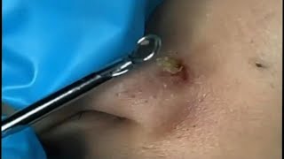 Big Cystic Acne Blackheads Extraction  Blackheads amp Milia  Whiteheads amp Comdones  Pimple Popping [upl. by Pearce]