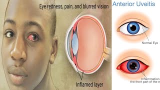 Uveitis  Part 1  Opthalmology [upl. by Ruff]