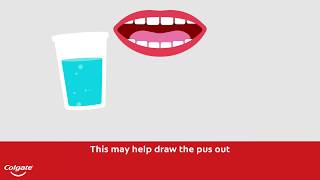 How To Treat a Gum or Tooth Abscess  Colgate® [upl. by Yrrol]