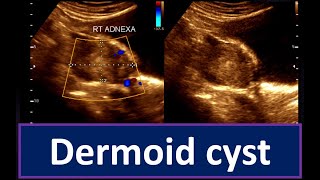 Understanding Dermoid Cyst  Guide to Ultrasonogram Diagnosis Ovarian Cyst  Practical Ultrasonogram [upl. by Eirrehc]