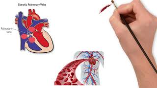 Pulmonary valve stenosis [upl. by Aticnemrac]