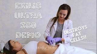 EXILIS ULTRA DEMONSTRATION BODY  Exilis Ultra 360 Experience at EuroPhoria [upl. by Katzir]