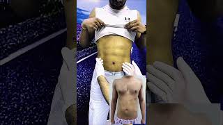 6 Pack Liposuction 1Week Results  Dr Nakul Somani  Cosmetic Surgeon in Jaipur [upl. by Lundin]