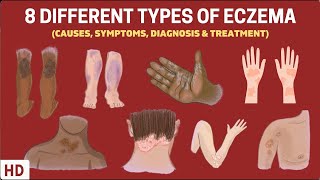 Eczema Exposed 8 Types You Need to Know [upl. by Nnaesor]