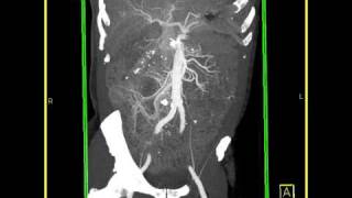 Abdomen Small Bowel Carcinoid tumor of the small bowel MIP images [upl. by Aggappe]