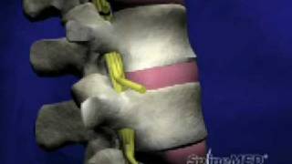 SpineMED® Decompression System Patient Education Video [upl. by Madelaine]