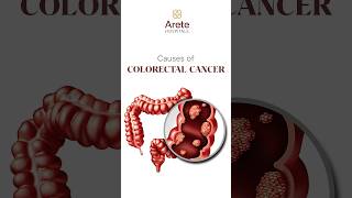 Understanding Colon Cancer Risk Factors and Causes  Dr Sharvani Duba Arete Hospitals coloncancer [upl. by Mayor]