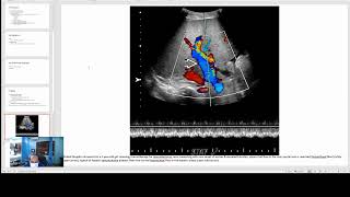 Hepatic Venoocclusive Disease [upl. by Manda659]