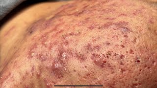 ACNE TREATMENT BO NGUYỄN  Blackheads Removal On Boy 2024FULL [upl. by Attiuqaj34]