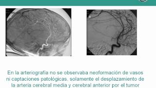 NeurorgsnetTumor cerebral de hemisferio derecho [upl. by Poole]