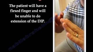 Mallet Finger  Everything You Need To Know  Dr Nabil Ebraheim [upl. by Ahsoem896]