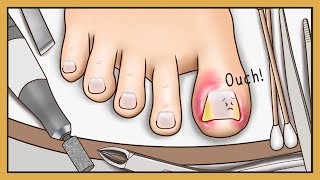 Tingle ASMR Animation Ingrown Toenail Removal with Stimulating Sound  Ondong  Happy Lemon [upl. by Kerrie738]