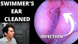 Swimmers Ear Cleaned With Suction Outer Ear Infection [upl. by Azial]