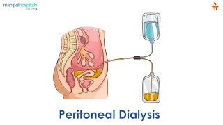 What is Peritoneal dialysis l Manipal Hospitals Bengaluru [upl. by Htebirol]